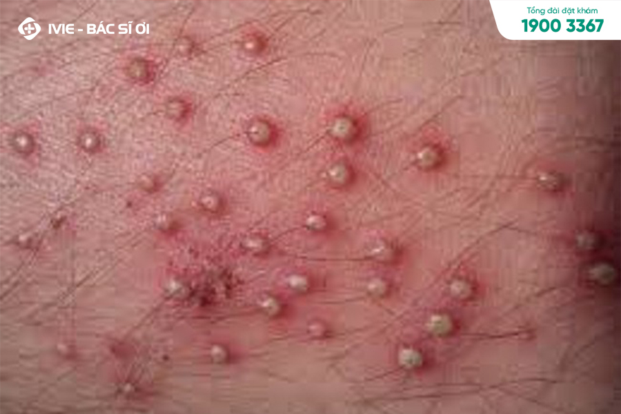 Viêm nang lông là một trong những triệu chứng của viêm da nhiễm khuẩn