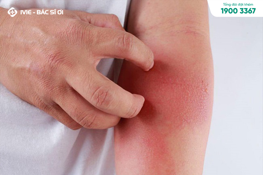 Không gãi, cào vùng da bị nhiễm khuẩn