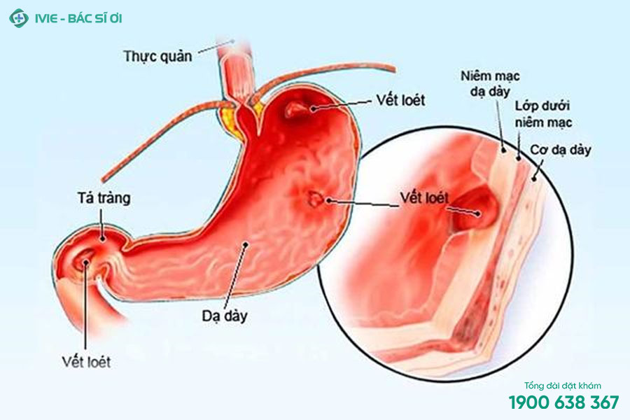 Hiện tượng viêm loét đường tiêu hóa gây đau bụng thường gặp ở trẻ