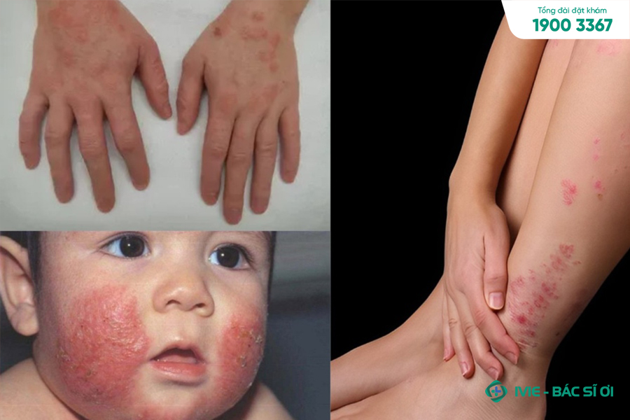 Bệnh chàm (Eczema)