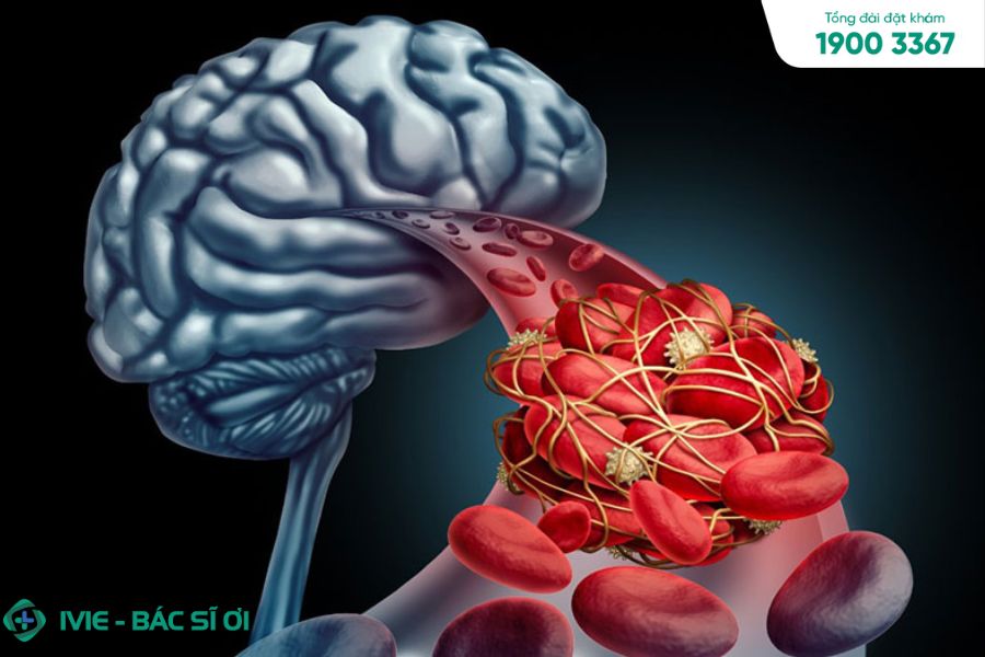 Tắc nghẽn mạch máu não gây đột quỵ ở trẻ em