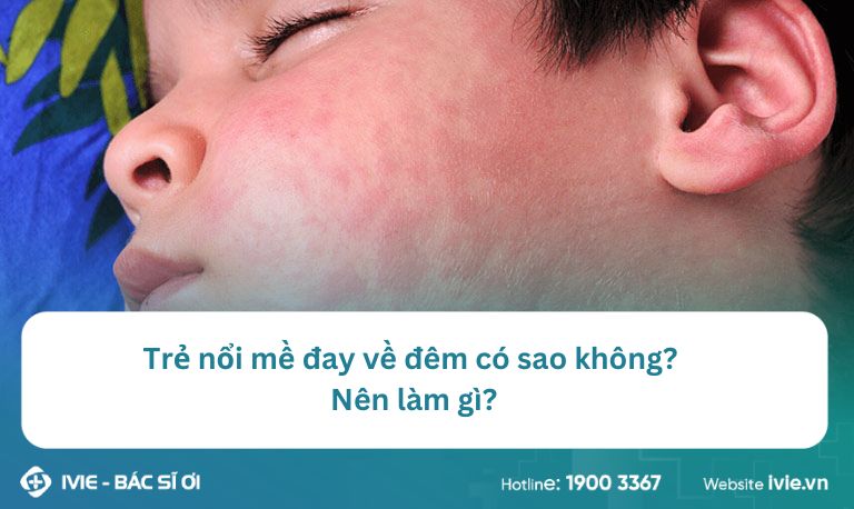 Trẻ nổi mề đay về đêm có sao không? Nên làm gì?