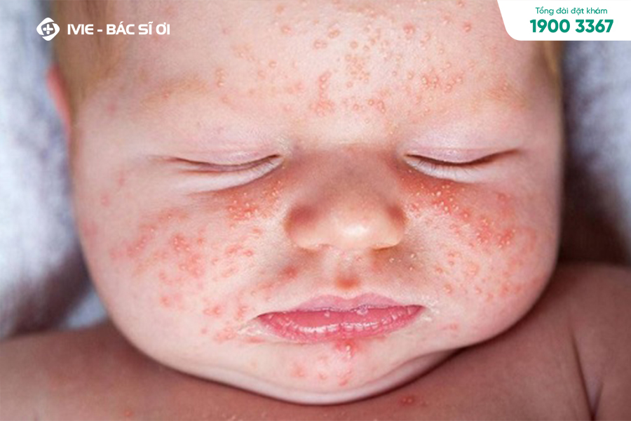 Những triệu chứng xuất hiện mẩn đỏ ở trẻ sơ sinh