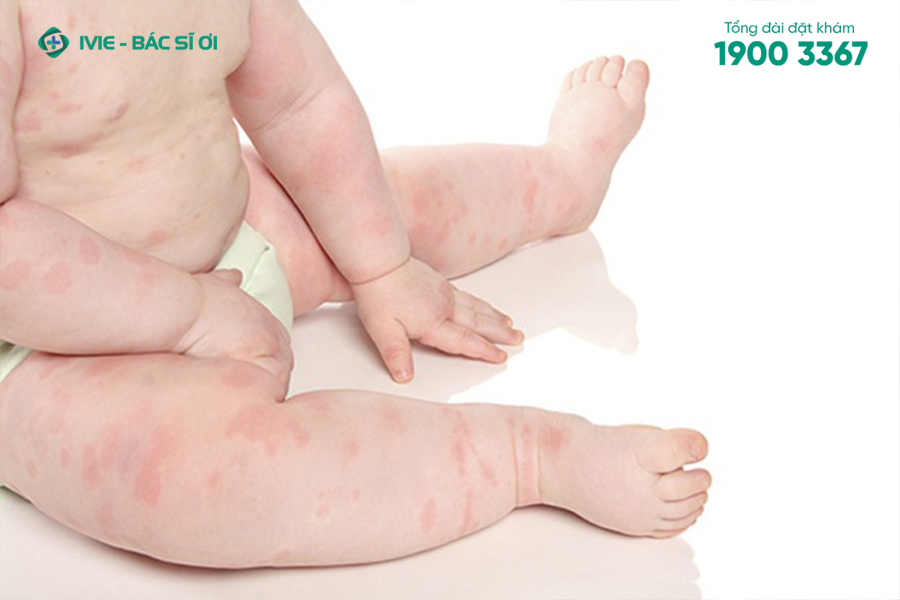 Trẻ có thể nổi mẩn ở toàn thân