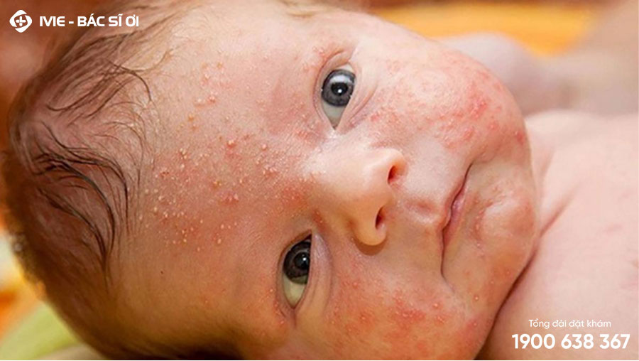 Hình ảnh trẻ sơ sinh bị mẩn đỏ trên mặt 