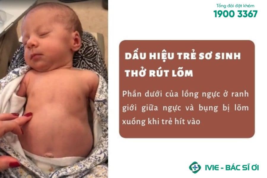 Hình ảnh minh họa dấu hiệu rút lõm lồng ngực ở trẻ