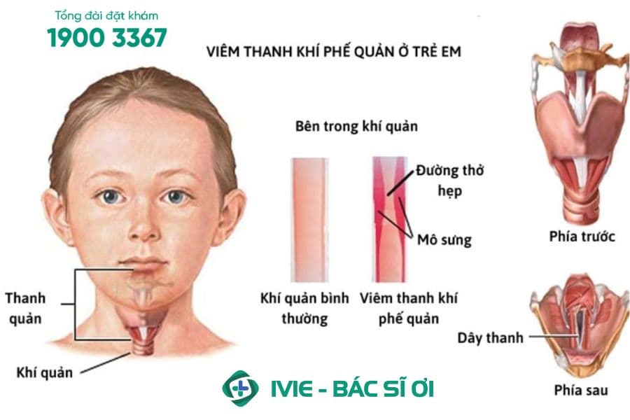 Tình trạng viêm thanh khí quản ở trẻ