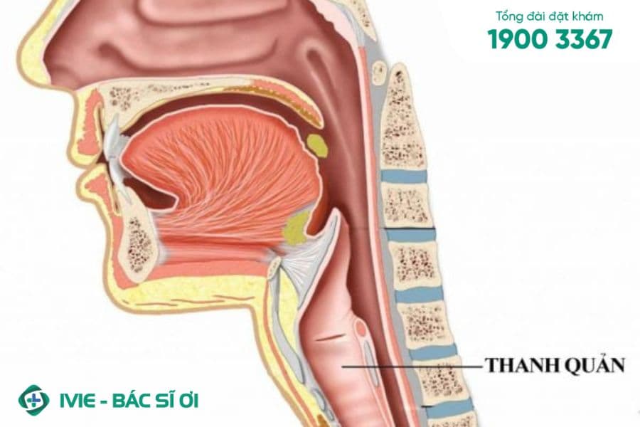 Hẹp thanh quản bẩm sinh