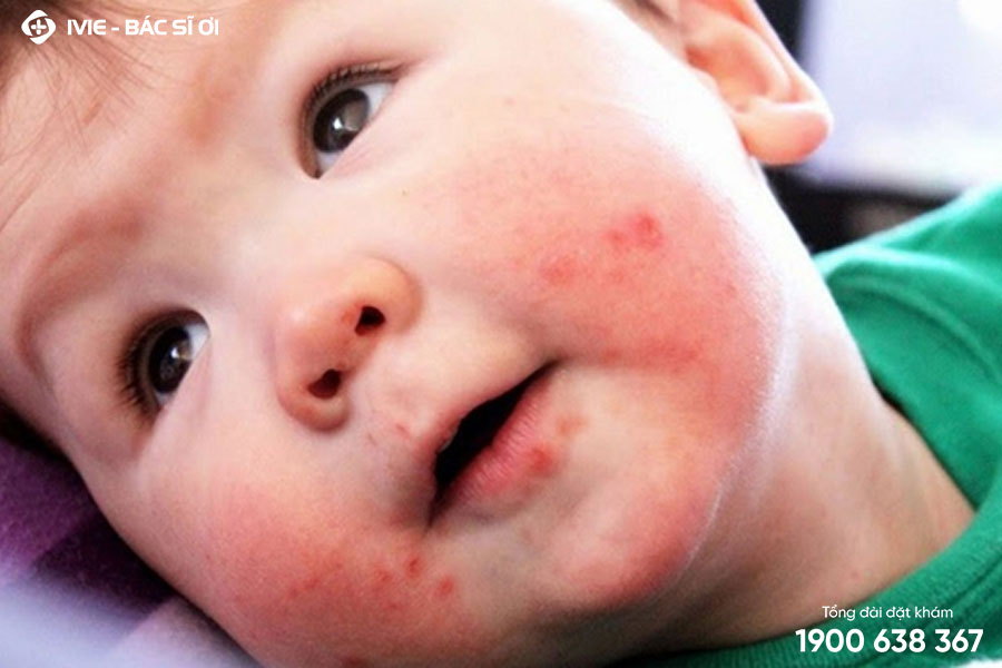 Trẻ sơ sinh bị nổi mẩn đỏ ở mặt do hiện tượng phát ban đỏ