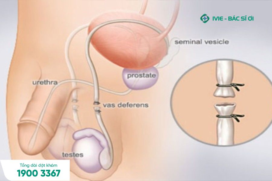 Triệt sản nam bao nhiêu tiền?