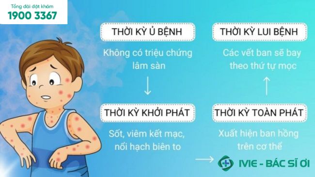 Sởi có 4 thời kỳ bệnh: Ủ bệnh, khởi phát, toàn phát, lui bệnh