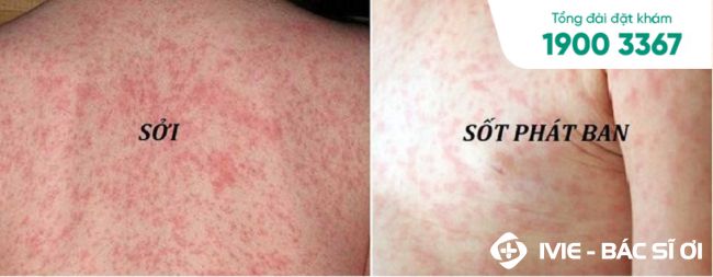 Đặc điểm giúp cha mẹ phân biệt bệnh sởi và sốt phát ban