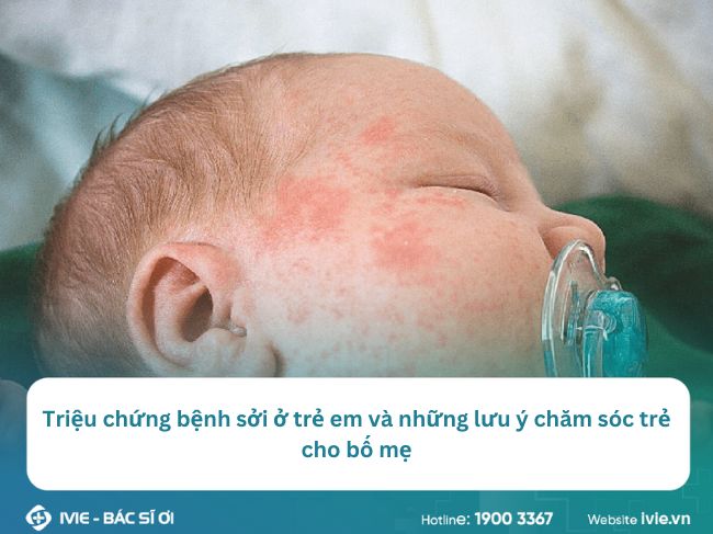 Triệu chứng bệnh sởi ở trẻ em và những lưu ý chăm sóc trẻ...