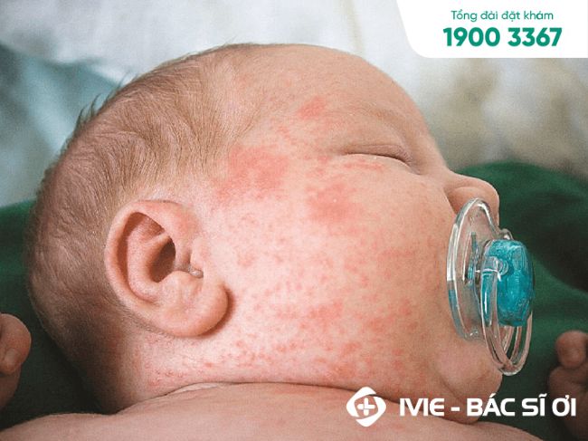 Những nốt ban xuất hiện đầu tiên ở 2 bên tai, vùng đầu mặt của trẻ