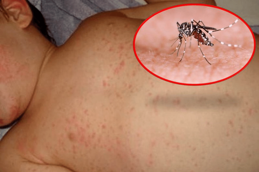 Triệu chứng của sốt xuất huyết Dengue