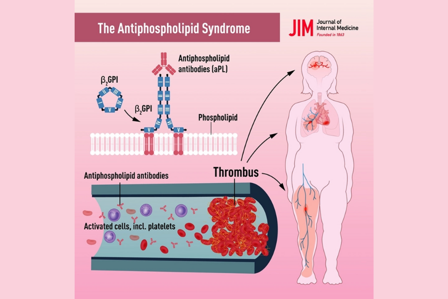 Triệu chứng hội chứng kháng phospholipid
