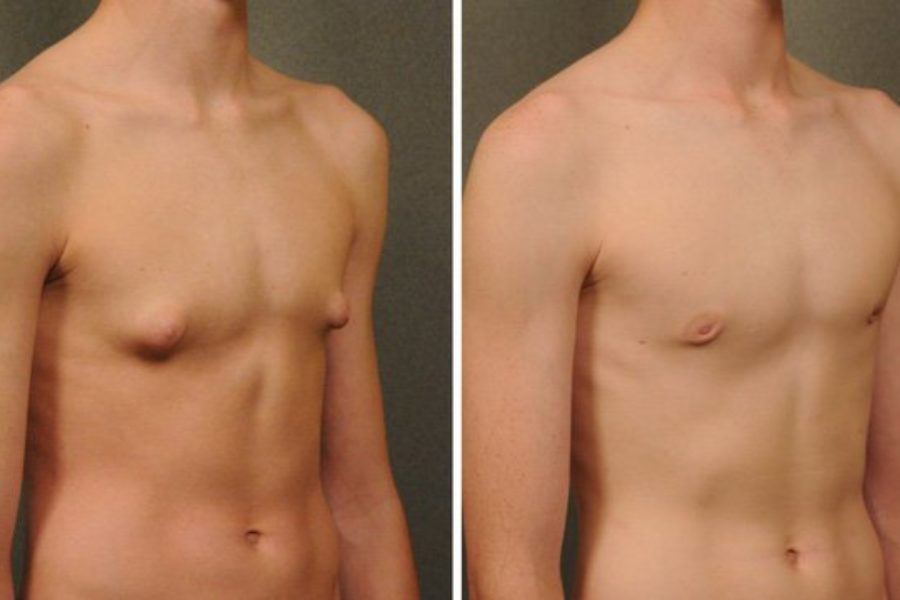 Người mắc hội chứng Klinefelter có ngực phát triển to hơn