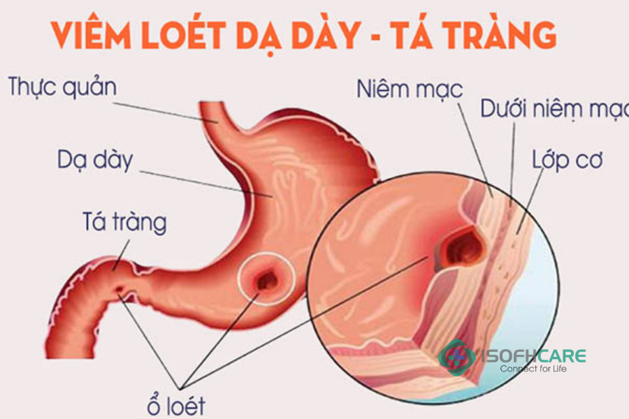 8+ triệu chứng thường gặp của bệnh viêm loét dạ dày tá tràng