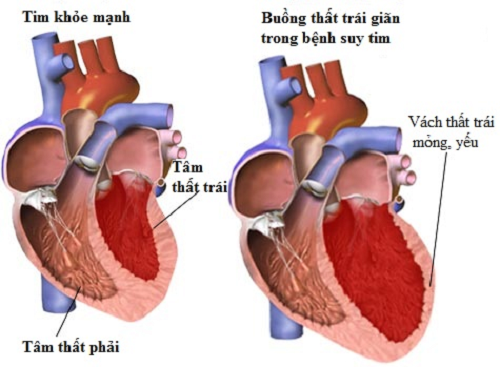 Triệu chứng suy tim