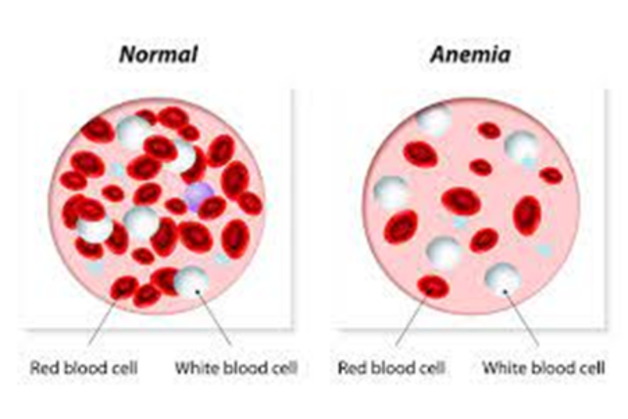 Triệu chứng thiếu máu liên quan đến bệnh beta thalassemia có thể từ nhẹ đến nặng