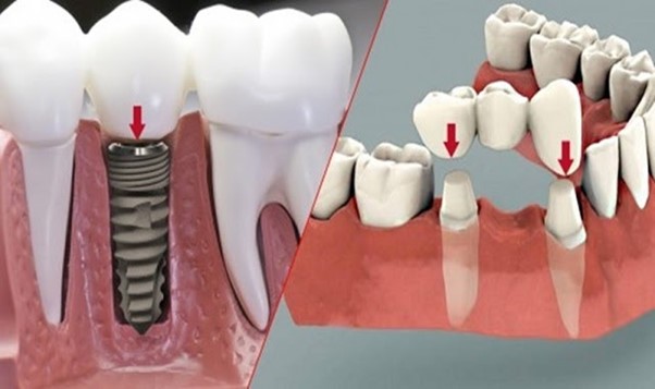 Nên lựa chọn trồng răng bắc cầu hơn hay trồng răng implant...