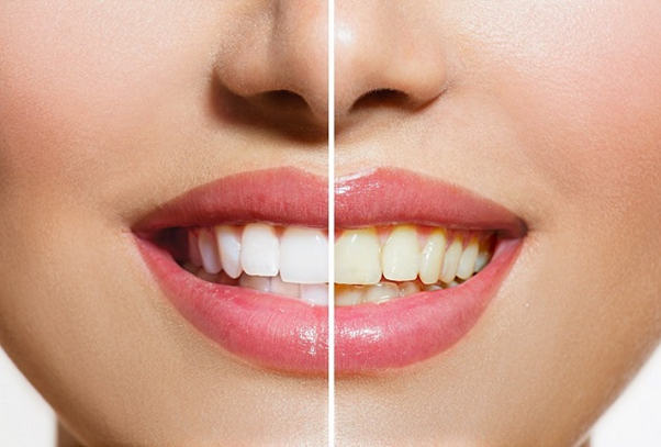 Hình ảnh trước và sau khi bọc răng sứ Titan