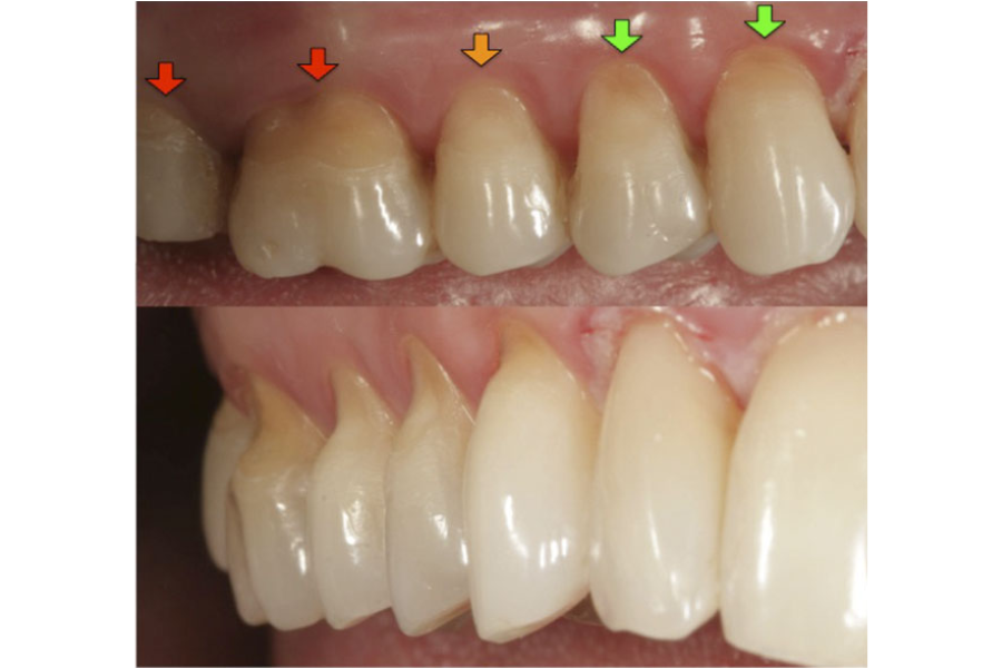 Hình ảnh trước và sau khi trám phục hồi mòn cổ răng bằng Composite