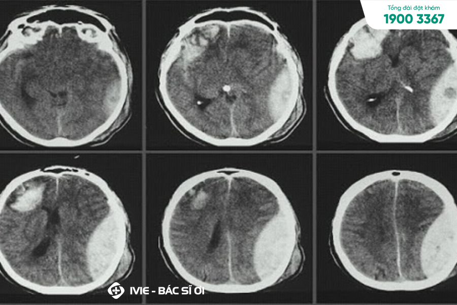 Chụp X quang não là phương pháp chẩn đoán hình ảnh để phát hiện các bệnh lý về sọ não