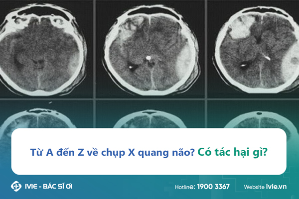 Từ A đến Z về chụp X quang não? Có tác hại gì?