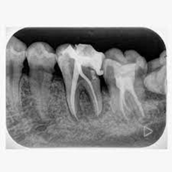 Tủy răng không có khả năng phục hồi