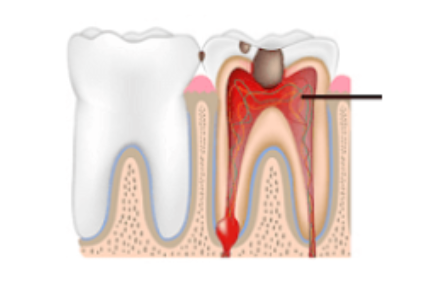 Tủy răng bị viêm do lỗ sâu vào tủy