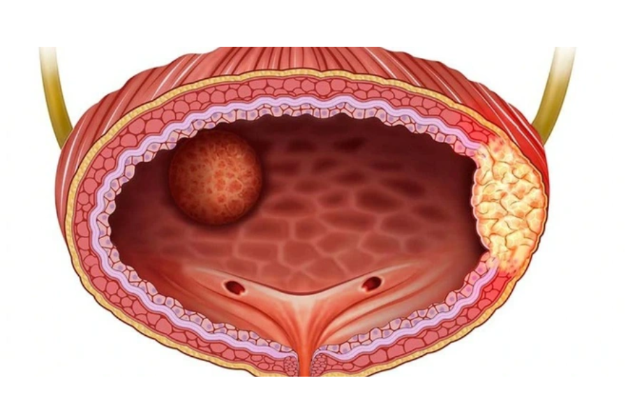 Hình ảnh minh họa khối u bàng quang