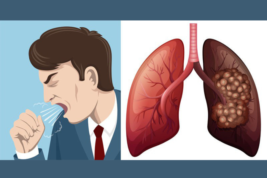 Chẩn đoán hình ảnh ung thư phổi