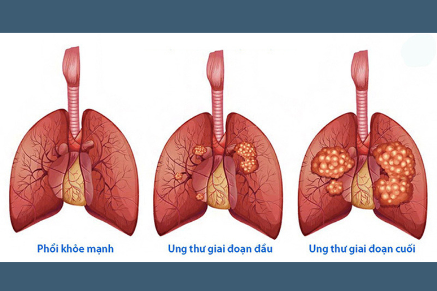 Tử vong do ung thư phổi nhiều hơn số tử vong do ung thư vú, tiền liệt tuyến và đại trực tràng cộng lại