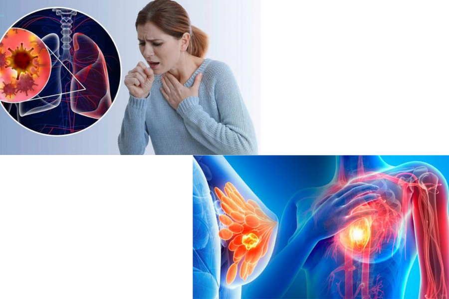 Ung thư vú và ung thư phổi, 2 loại ung thư có thể gây bệnh màng ngoài tim