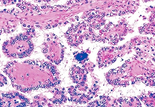 Hình ảnh mô bệnh học của ung thư giáp thể nhú