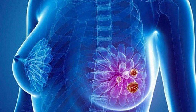 Làm thế nào để phát hiện sớm bệnh ung thư vú?