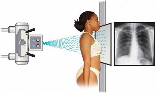 Ưu điểm chụp X quang tim phổi