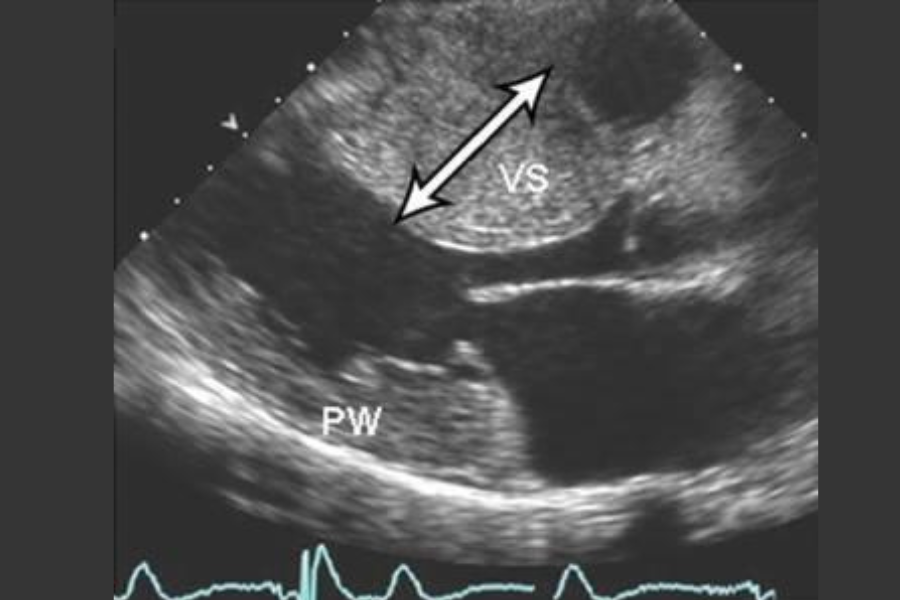 Vách liên thất (mũi tên trắng) phì đại lớn làm hẹp đường ra thất trái đáng kể trên siêu âm tim