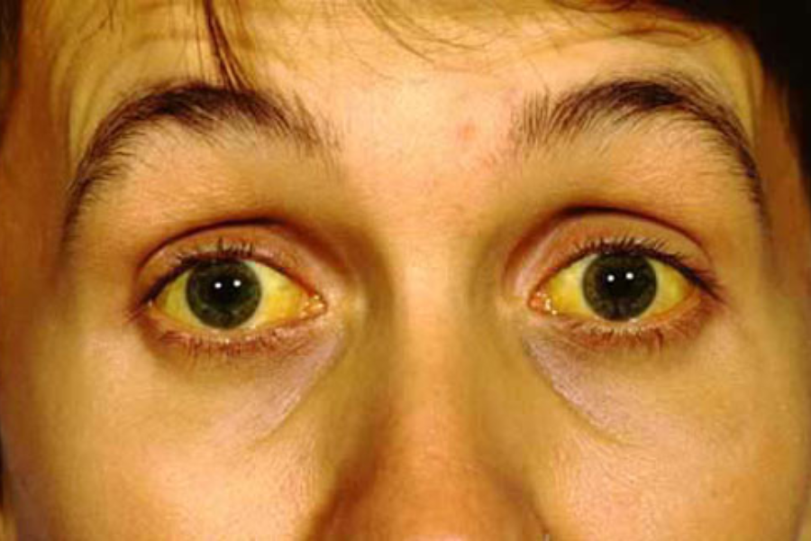 Người bệnh có triệu chứng vàng củng mạc mắt