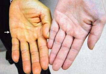 Hội chứng vàng da: những nguyên nhân dẫn đến bệnh?