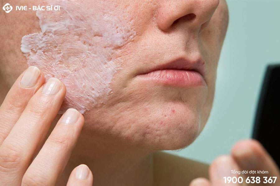 Vảy nến da mặt là một bệnh da liễu mạn tính, thường xuất hiện với vảy nến da đầu và các bộ phận khác