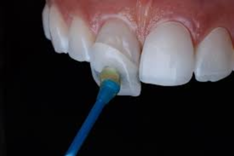 Veneer: phương pháp phục hồi thẩm mỹ cho răng được sử dụng nhiều hiện nay.