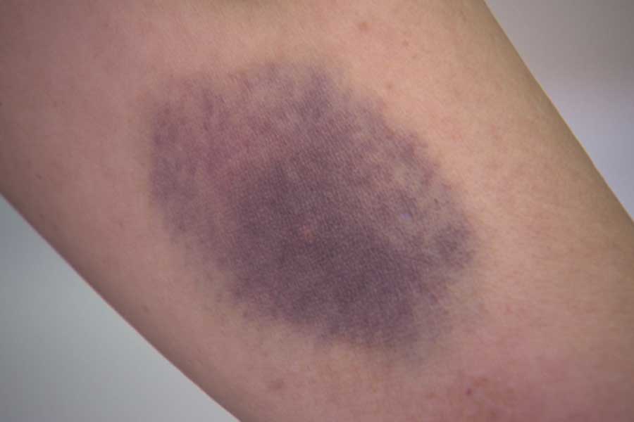 Vết bầm tím trên da thường do tổn thương