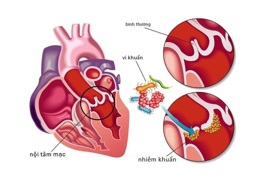 Vi khuẩn gây tổn thương van tim