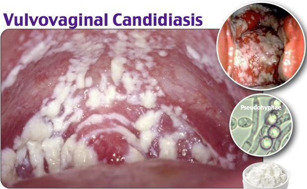 Triệu chứng của viêm âm đạo do nấm Candida