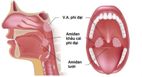 Phân biệt viêm amidan mãn tính và cấp tính