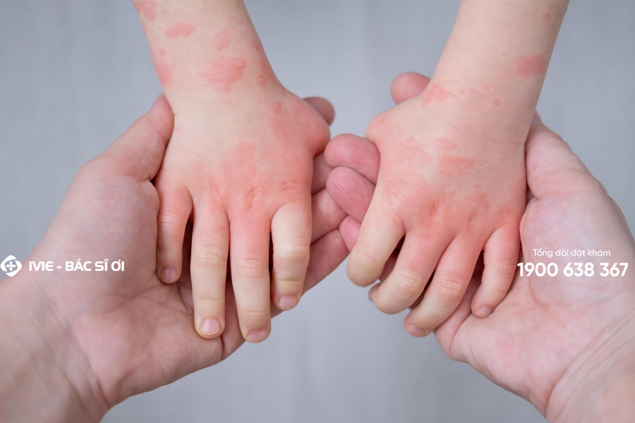 Mẩn đỏ thường là một biểu hiện của các bệnh lý như viêm nhiễm, dị ứng hoặc bệnh truyền nhiễm