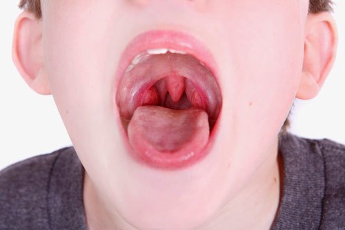 Viêm họng thường xuất hiện ở trẻ em.