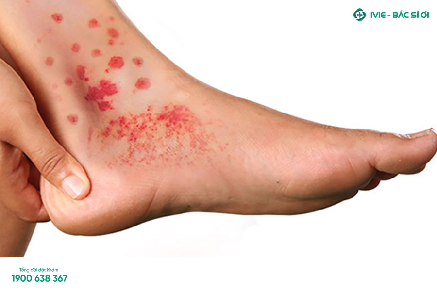 Viêm mạch gây nổi mẩn đỏ ở chân riêng lẻ hoặc thành từng đám